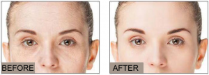 Reduces and fades wrinkles in 1 to 7 days