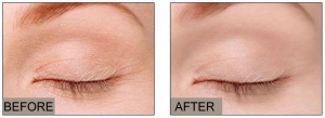 Reduce crow's feet and wrinkles in 8 to 15 days